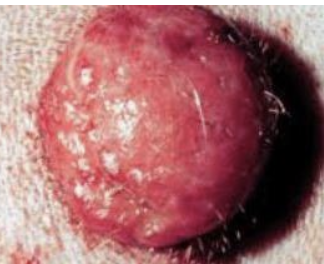 <p>benign tumors of langerhans DCs in the skin, grow rapidly (1-4 weeks)</p>