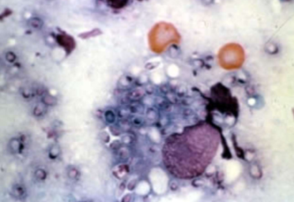 <p>what does <span style="color: rgb(255, 255, 255);"><span>Histoplasma capsulatum cause </span></span></p>