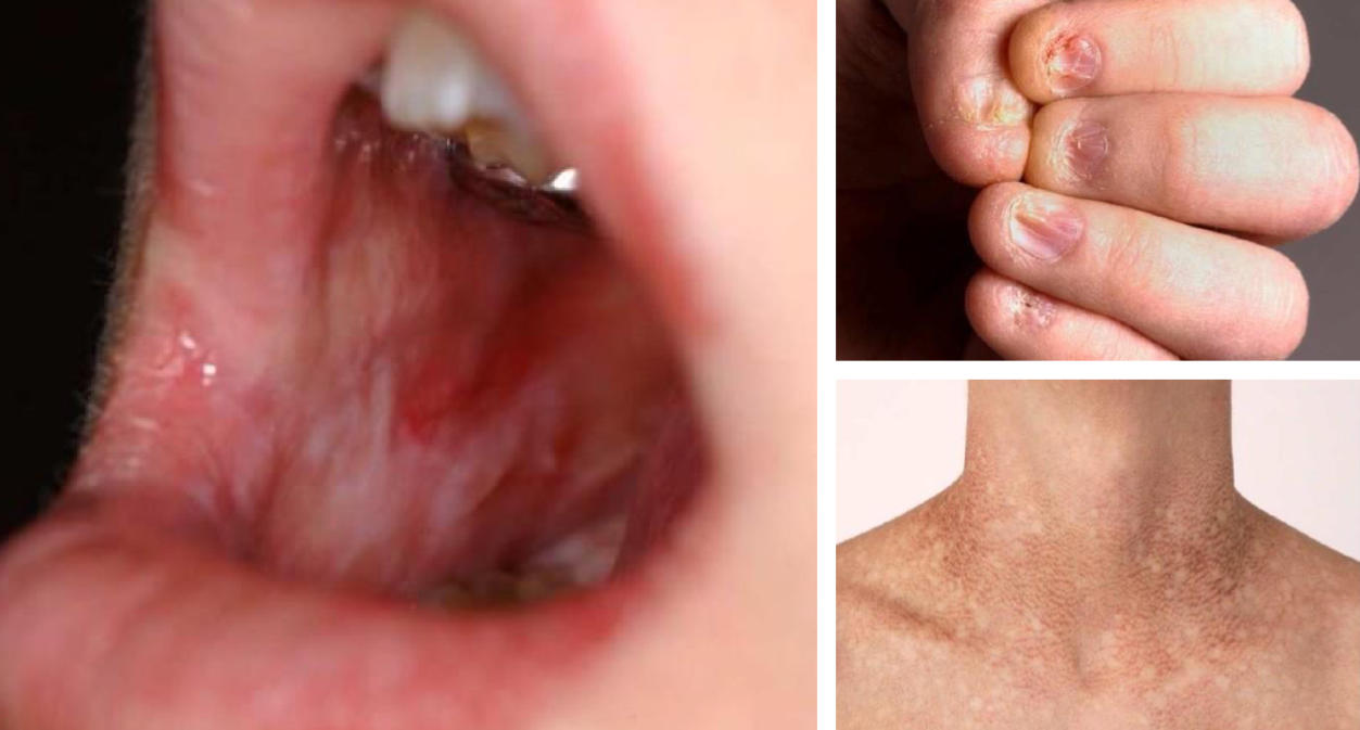 <p>which hereditary lesion clinical features:</p><ul><li><p>Apparent during first decade</p></li><li><p>Nail dystrophy</p></li><li><p>Oral leukoplakia</p></li><li><p>Abnormal skin pigmentation</p></li></ul><p></p>