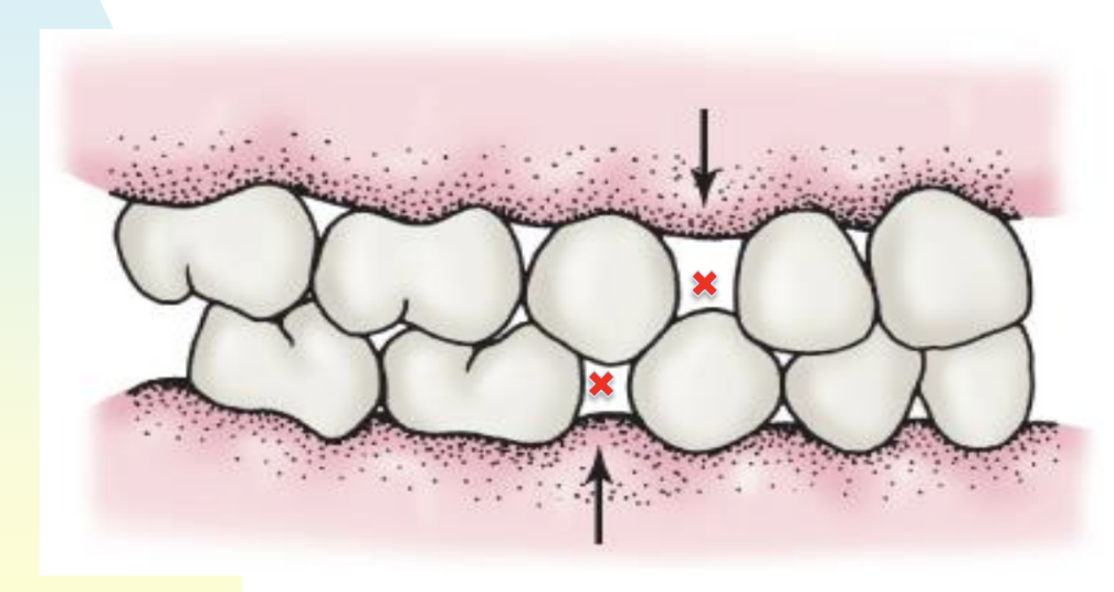 <p>Primate spaces aka largest diastema (teeth gaps) are naturally occuring spaces between primary dentition. </p><ul><li><p>located mesial to max primary canine and distal to mand canines </p></li></ul><p>**these diastemae form because teeth remain the same size as the jaw grows horizontally and vertically </p><p></p>