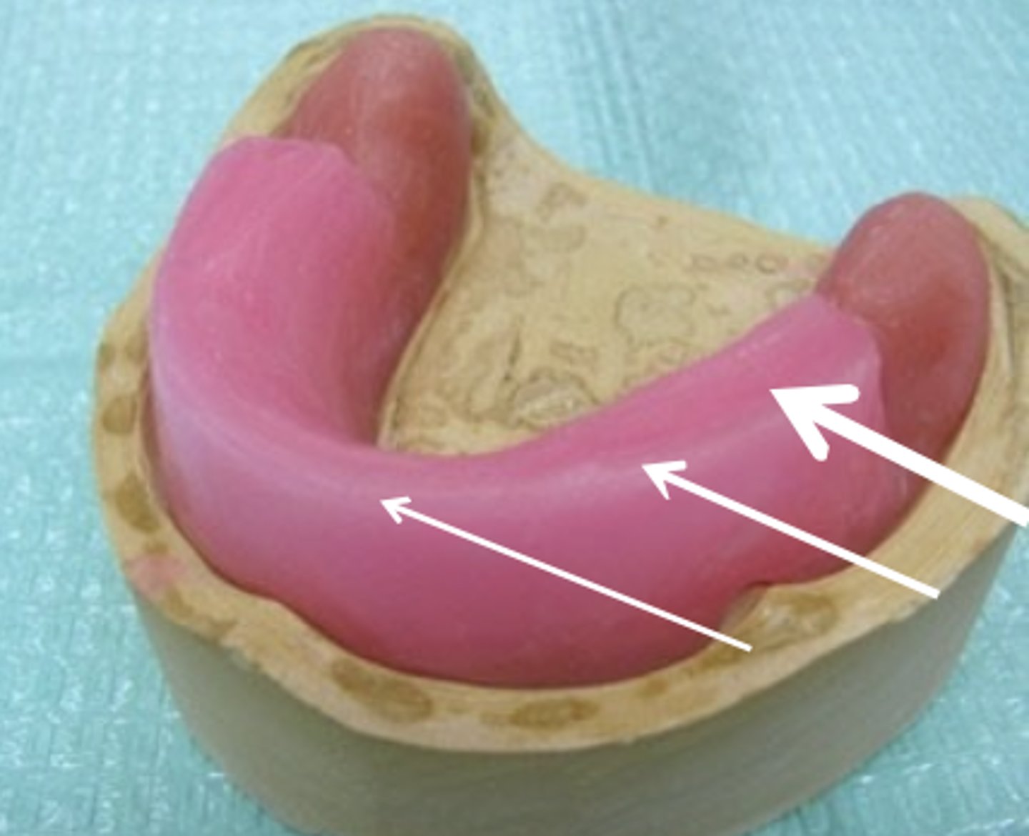 <p>What are the varying widths of the mandibular wax rim?</p>