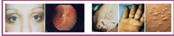 Severe hypertriglyceridemia