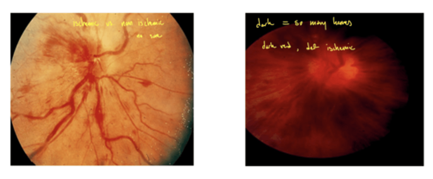 <p>dark blood red fundus</p><p>left - not sure which type</p><p>right - must be ischemic</p>