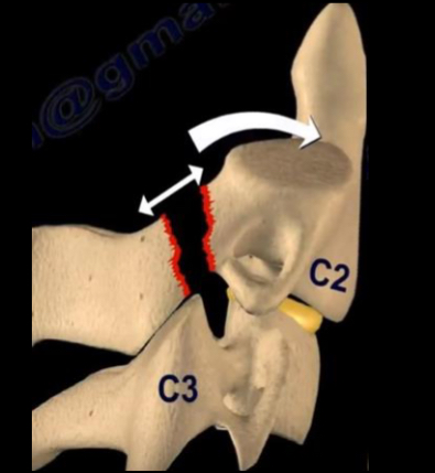 <p>Historically due to hanging but also seen<br>in RTC’s where the face strikes the<br>windscreen forcing the neck into<br>hyperextension.<br>• Hyperextension and distraction results<br>in bilateral fractures through the pedicles<br>of the axis (C2), with anterior dislocation<br>of the body and subsequent tearing of<br>the spinal cord</p>