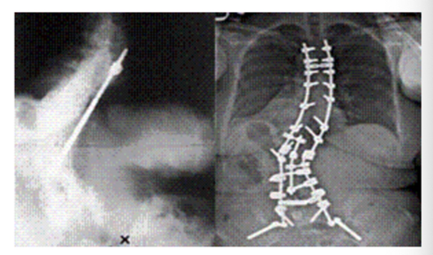 <p>This picture shows Harrington rod : is used to treat lordosis.</p><p>(T/F)</p>
