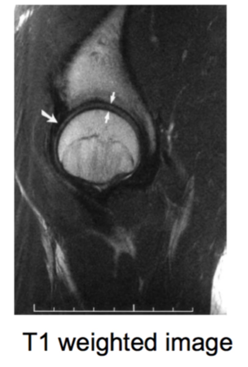 <p>- acetabular rood<br>- iliopsoas muscle<br>- SI joints<br>- pubic symphysis</p>