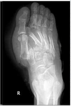 <p>condition characteristized by disruption <strong>between the articulation of the medial cuneiform &amp; base of the second metatarsal</strong></p>
