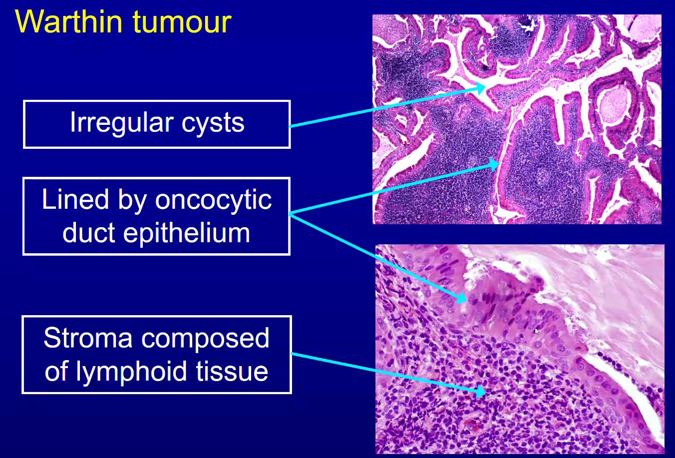 <p>stroma has dark blue dots - lymphocytes</p>
