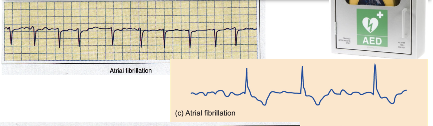 Age, ↑↑↑ blood pressure, heart disease, obesity, sleep apnea, thyroid disorders, & excessive alcohol or caffeine intake.
