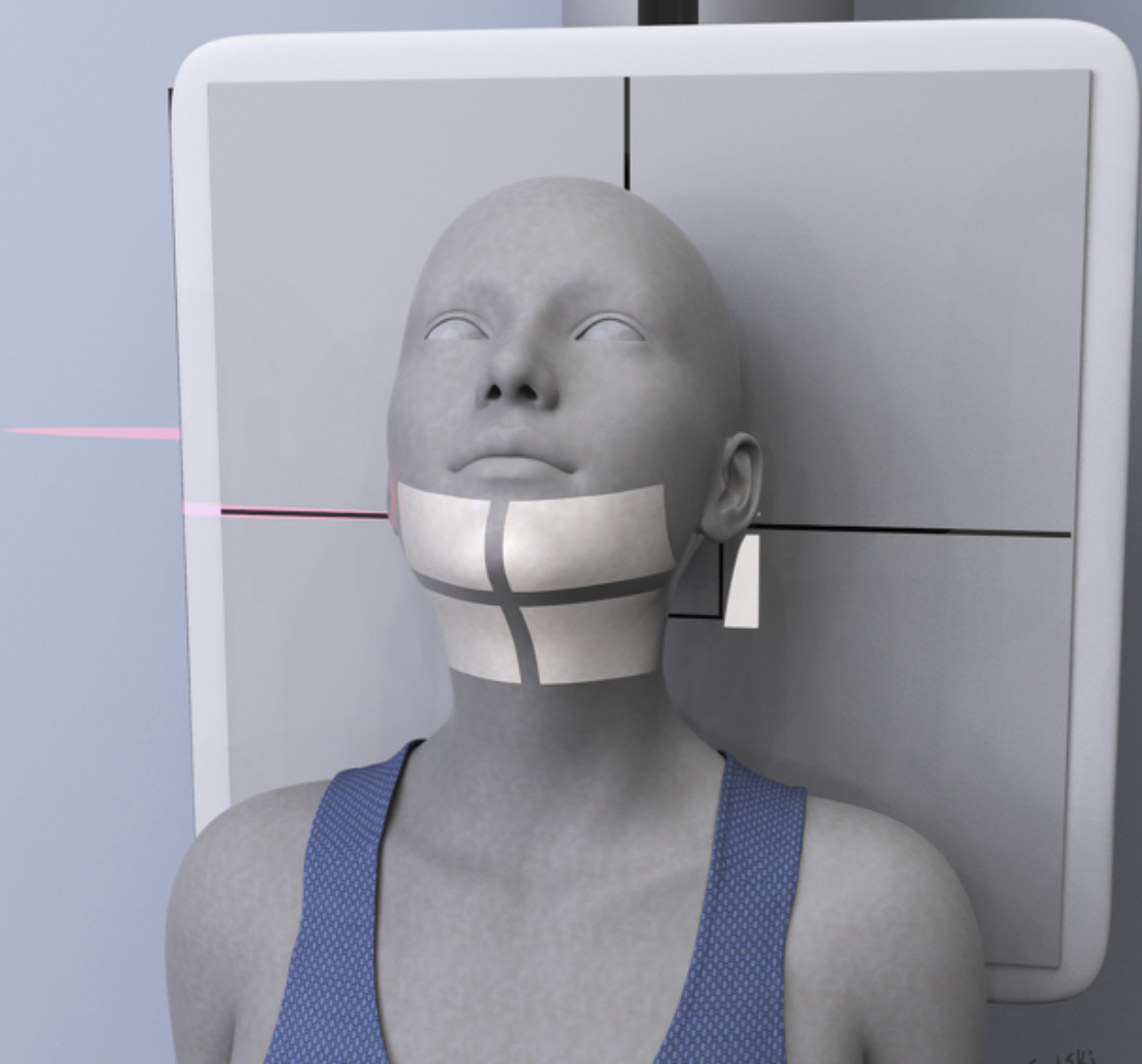 <p>Pt position: supine/upright. Chin raised to bring  earlobe and tip of chin perpendicular to the board.</p><p>CR entrance: meaty part of distal chin.</p><p>tube angle: none</p><p>SID: 40”</p><p>Light field: 5×5</p><p>breathing:suspend</p><p>marker: in corner of light field. </p>