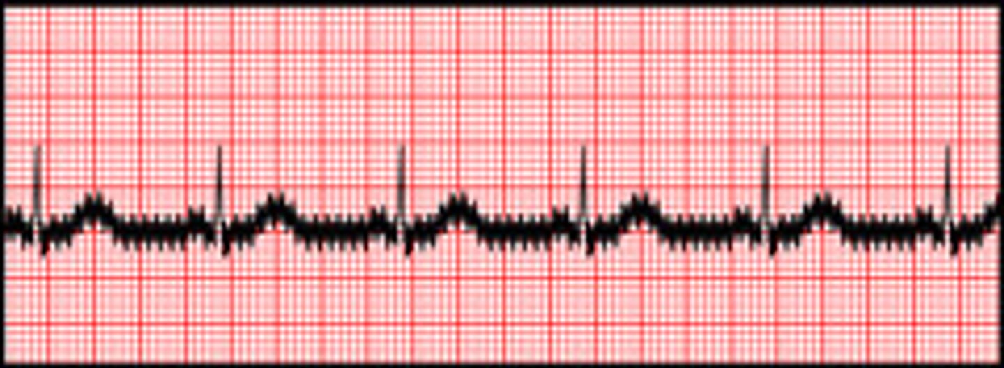 <p>improper grounding</p><p>(AC interference artifact)</p>