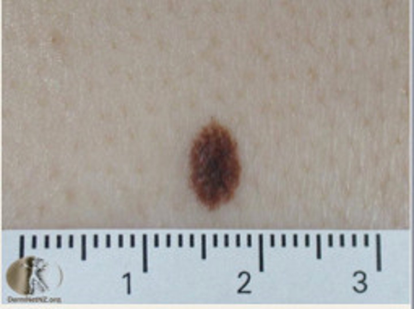 <p>diagnose this:</p><p>symmetric, tan/brown/pink, papules or macules</p>