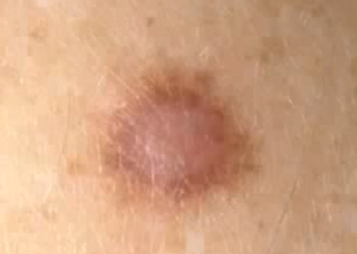 <p><b>Primary</b> <br><br>Marble like palpable lesion larger than 0.5 cm, often deeper and firmer than a papule <br><br>example: dermatofibroma</p>