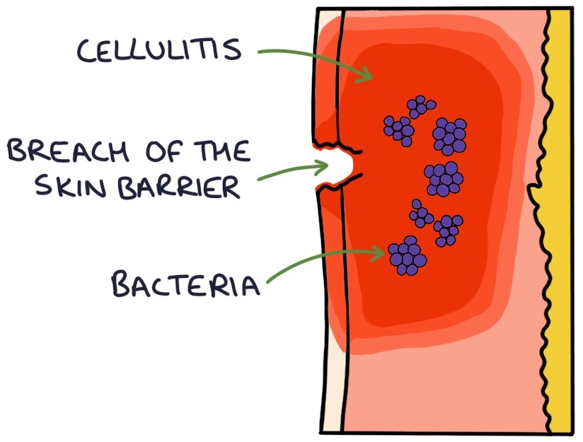 <p><span>When a patient presents with cellulitis, look for a breach in the skin barrier and a point of entry for the bacteria. This may be due to skin trauma, eczema, fungal nail infections or ulcers.</span></p><p></p>