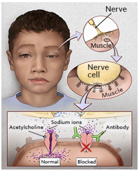 <p><strong>Chronic neuromuscular disease</strong> → causes <strong>skeletal muscle weakness</strong></p><ul><li><p><strong>Mechanism</strong>: autoantibodies attack <strong>nicotinic ACh receptors (nAChRs)</strong></p></li><li><p>Result: impaired <strong>neuromuscular transmission</strong> → reduced muscle contraction</p></li></ul><p></p>