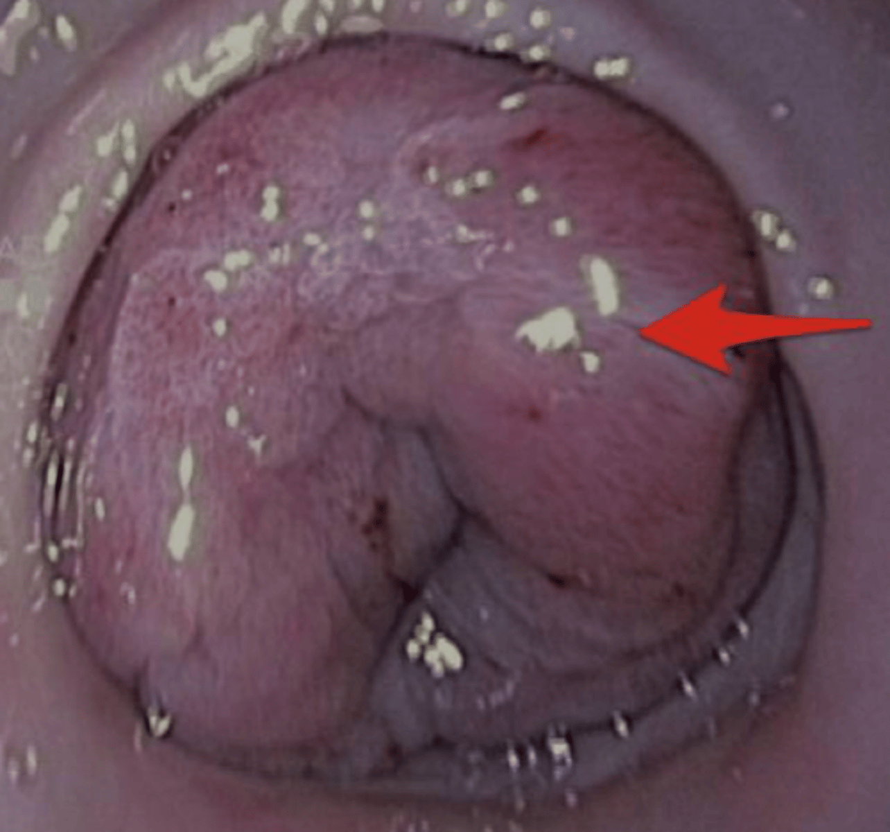 <p>What breeds most commonly get Pyloric stenosis?</p>