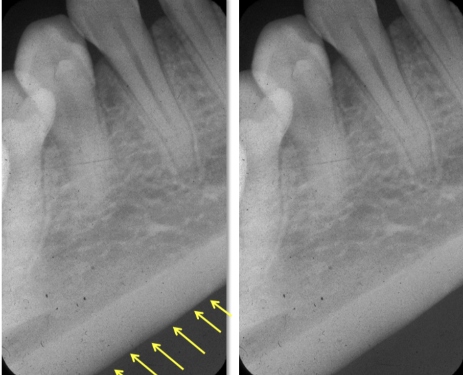 <p>It appears radio opaque due to the cortical bone.</p>