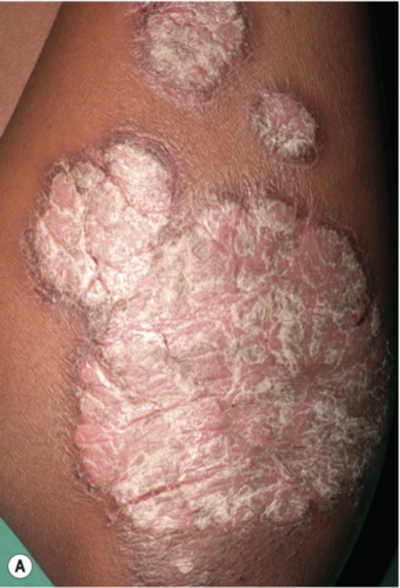 <p>A noncontagious inflammatory skin disease characterized by recurring reddish patches covered with silvery scales caused by uncontrolled T cell replication</p>