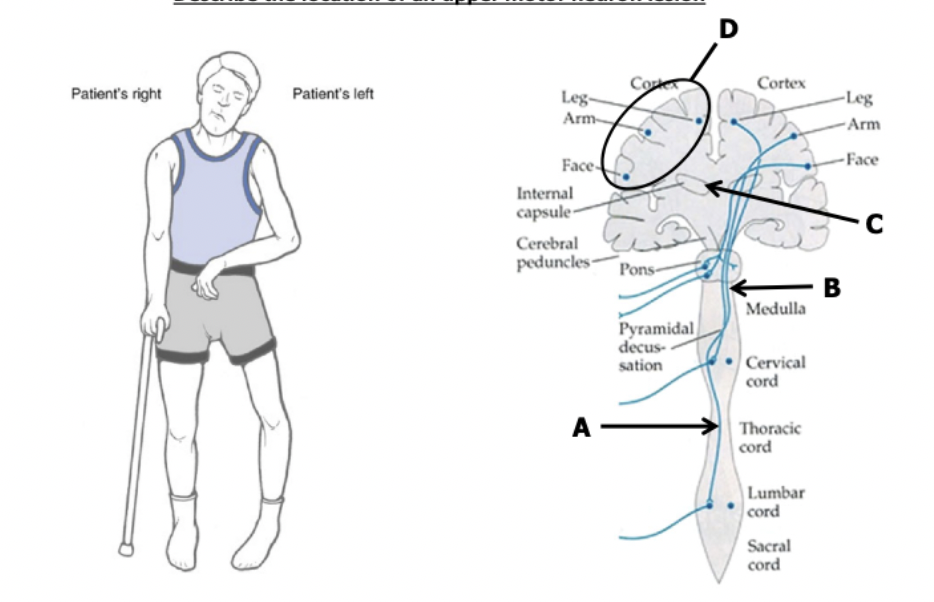 <p>where is the lesion most likely?</p><p>note: patient has no aphasia or speech dysfunction</p>