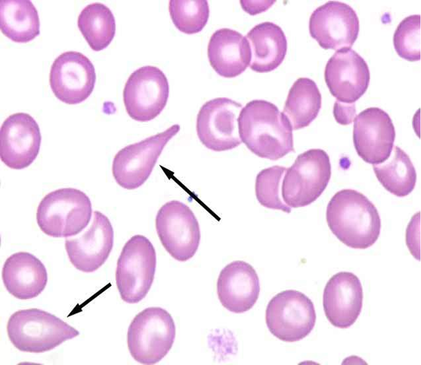 <p><span>cell which look as if one end has been pulled out to a tail while the other is still rounded</span></p>