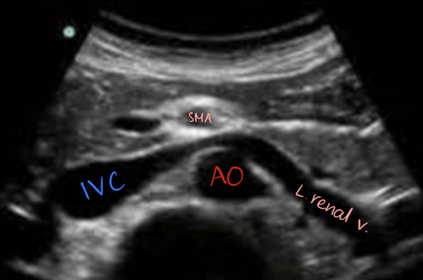 <ul><li><p><mark data-color="yellow" style="background-color: yellow; color: inherit;">posterior to SMA</mark></p></li><li><p><mark data-color="yellow" style="background-color: yellow; color: inherit;">anterior to AO</mark></p></li><li><p>LRV is longer than RRV</p></li></ul><p></p>