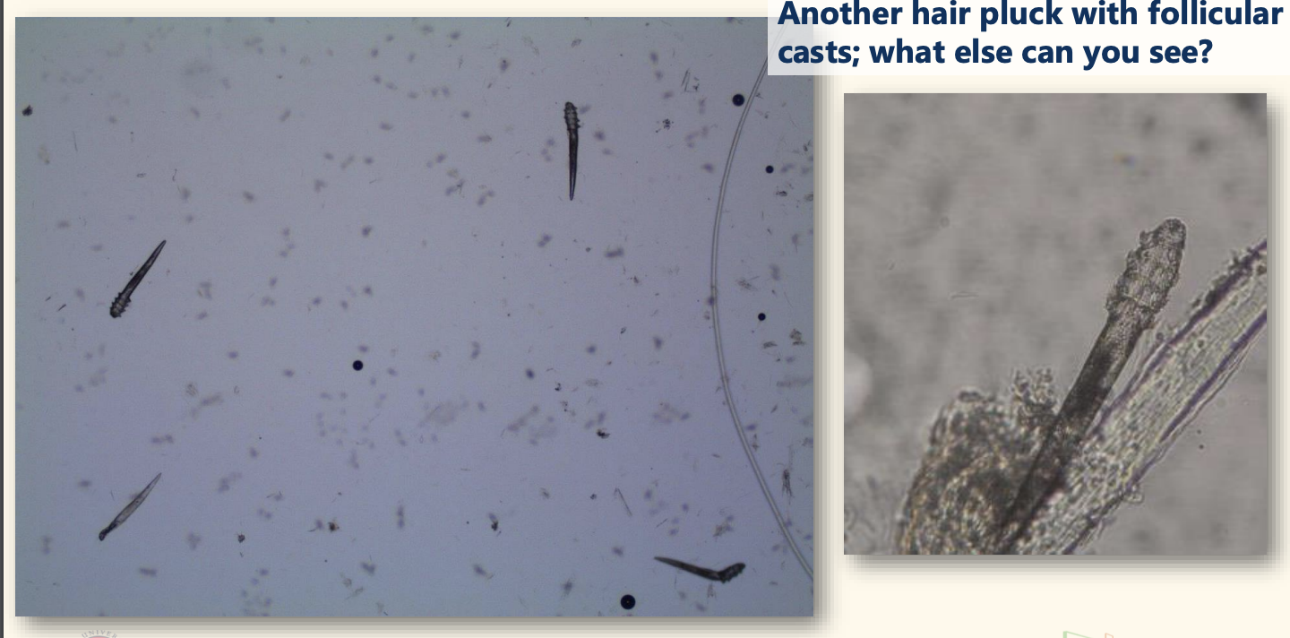 <p>Another hair pluck with follicular casts; what else can you see?</p>