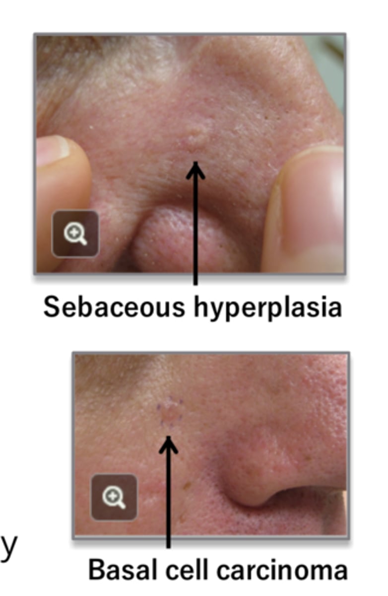 <p>How can you tell the difference between sebaceous hyperplasia and BCC?</p>