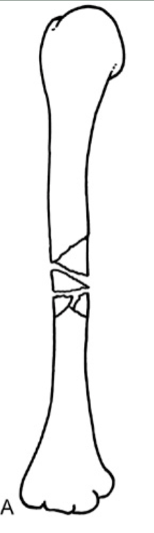 <p><strong>Which fracture?</strong></p>