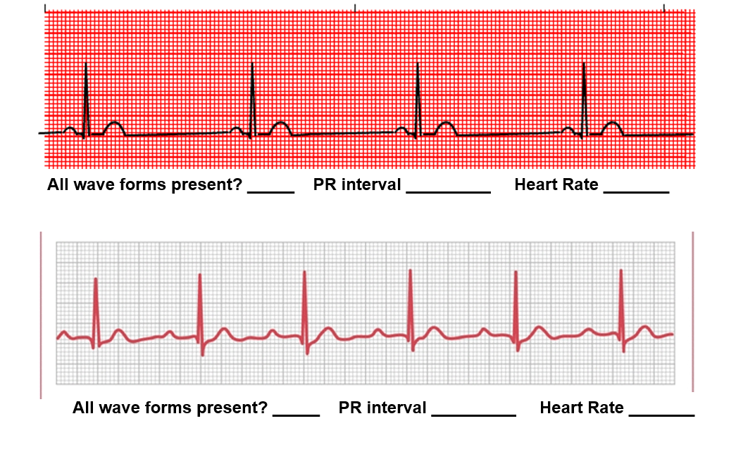 <p><strong>Top ECG Strip (red background)</strong></p><ul><li><p><strong>All wave forms present?</strong> <span data-name="check_mark_button" data-type="emoji">✅</span> Yes (P waves, QRS complexes, T waves are visible)</p></li><li><p><strong>PR interval</strong>: Start of P wave → start of QRS. Looks like ~4 small boxes = <strong>0.16 sec</strong> (normal).</p></li><li><p><strong>Heart Rate</strong>: Count large boxes between QRS complexes → about <strong>4 large boxes</strong>.</p><p>HR=300/4=75 bpm</p></li></ul><p><span data-name="check_mark" data-type="emoji">✔</span> <strong>Answer (Top):</strong> All wave forms present: Yes | PR interval: 0.16 sec | Heart Rate: 75 bpm</p><p><strong>Bottom ECG Strip (gray background)</strong></p><ul><li><p><strong>All wave forms present?</strong> <span data-name="check_mark_button" data-type="emoji">✅</span> Yes (P, QRS, T all present)</p></li><li><p><strong>PR interval</strong>: Also about ~4 small boxes = <strong>0.16 sec</strong></p></li><li><p><strong>Heart Rate</strong>: About <strong>5 large boxes</strong> between QRS peaks.</p><p>HR=300/5= 60 bpm</p></li></ul><p><span data-name="check_mark" data-type="emoji">✔</span> <strong>Answer (Bottom):</strong> All wave forms present: Yes | PR interval: 0.16 sec | Heart Rate: 60 bpm</p>