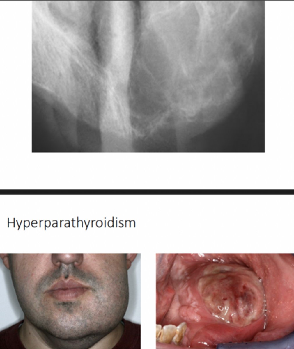 <p>central giant cell granuloma</p>