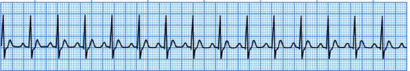 <p>What does this EKG show? </p>
