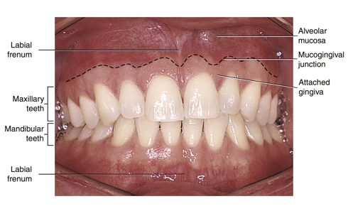 <ul><li><p>the line of demarcation between the firmer and pinker attached gingiva and the moveable and redder alveolar mucosa that lines the vestibules is the scalloped-shaped ___</p></li></ul><p></p>