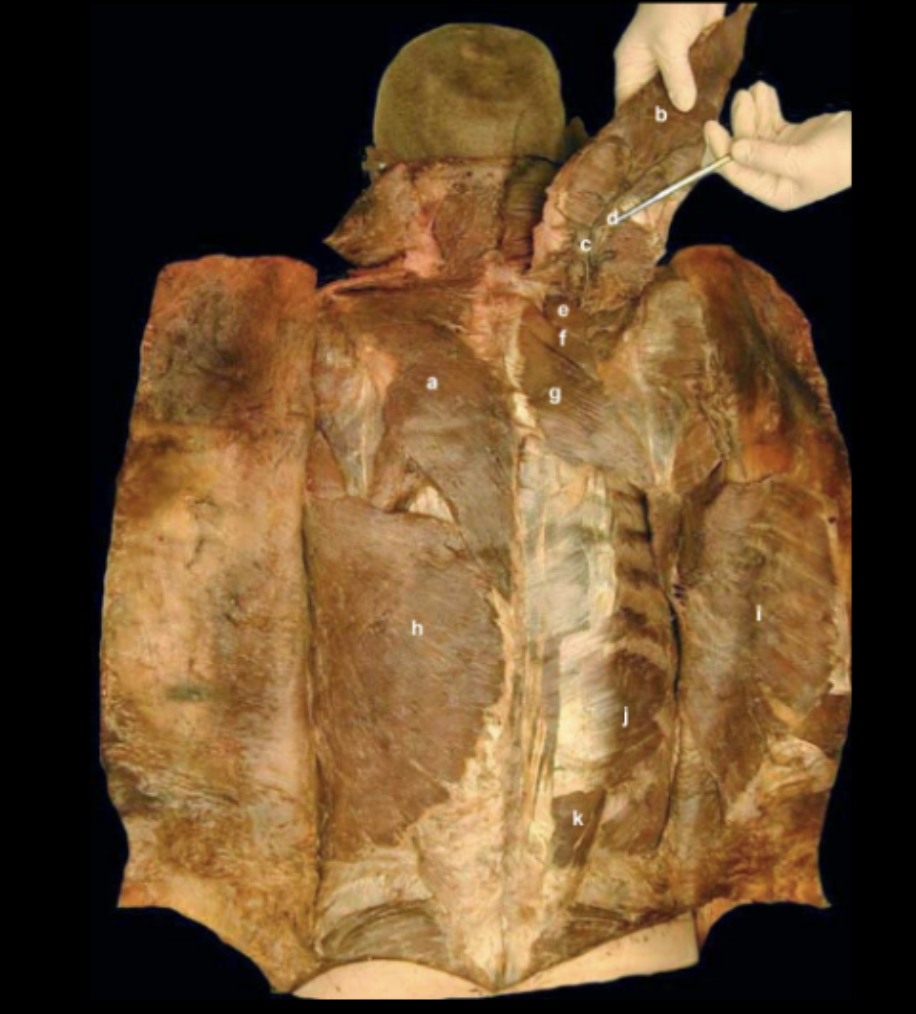 <p>Identify the Extrinsic Muscles of the Back (Trap &amp; Latissimus Dorsi muscles reflected)</p>