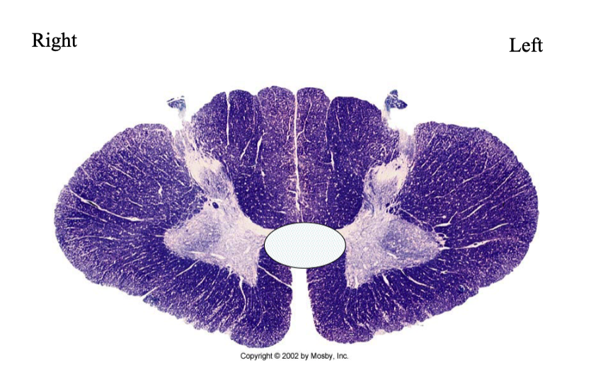 <p>What is lesioned here? What findings would you expect in this individual?</p>
