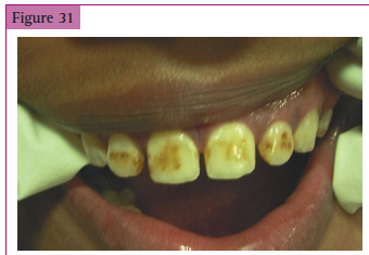 <p>___________________ in fluorosis</p>