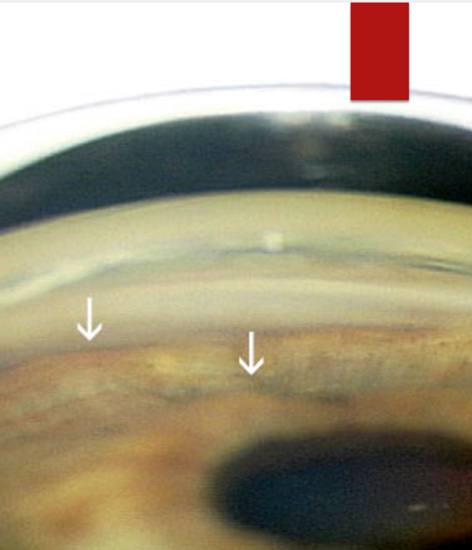 <p>Sine Wave - hump at ciliary body, hump at anterior lens</p>