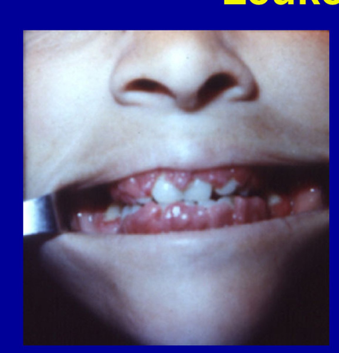 <p>Gingival enlargement and bleeding</p>