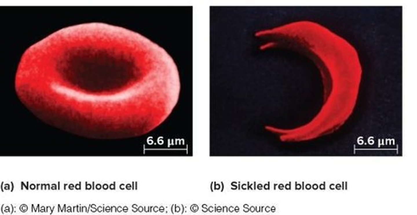 <p>An autosomal recessive disorder where affected individuals produce an abnormal form of hemoglobin.</p>