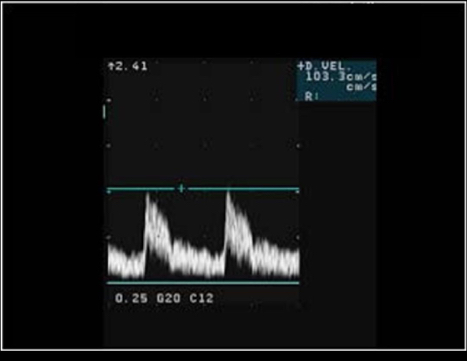 <p>Note the Doppler measurement on the image. What other Doppler measurement should be taken to calculate the resistive index?</p><p>A) end diastolic velocity </p><p>B) peak systolic velocity </p><p>C) end systolic velocity </p><p>D) peak diastolic velocity </p>