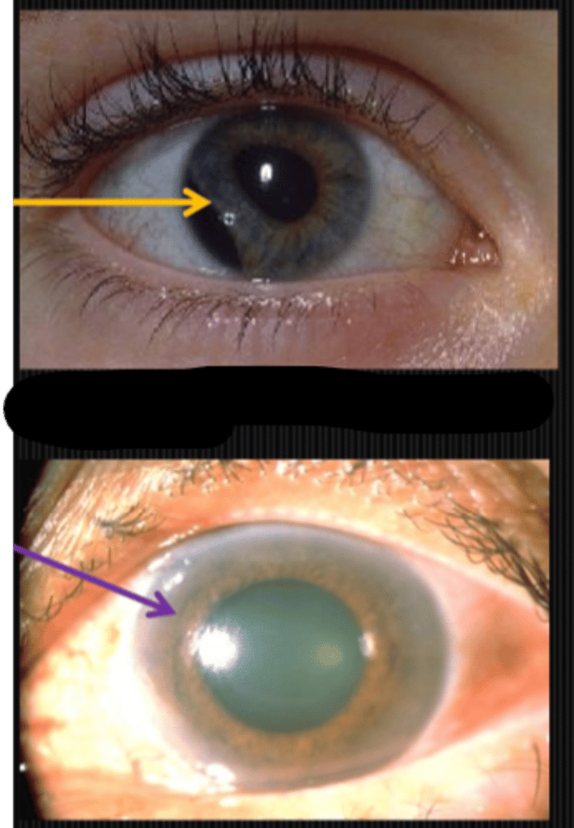 <p>posterior synechiae</p><p>ocular trauma</p><p>angle closure glaucoma = also vomiting, cornea edema</p>
