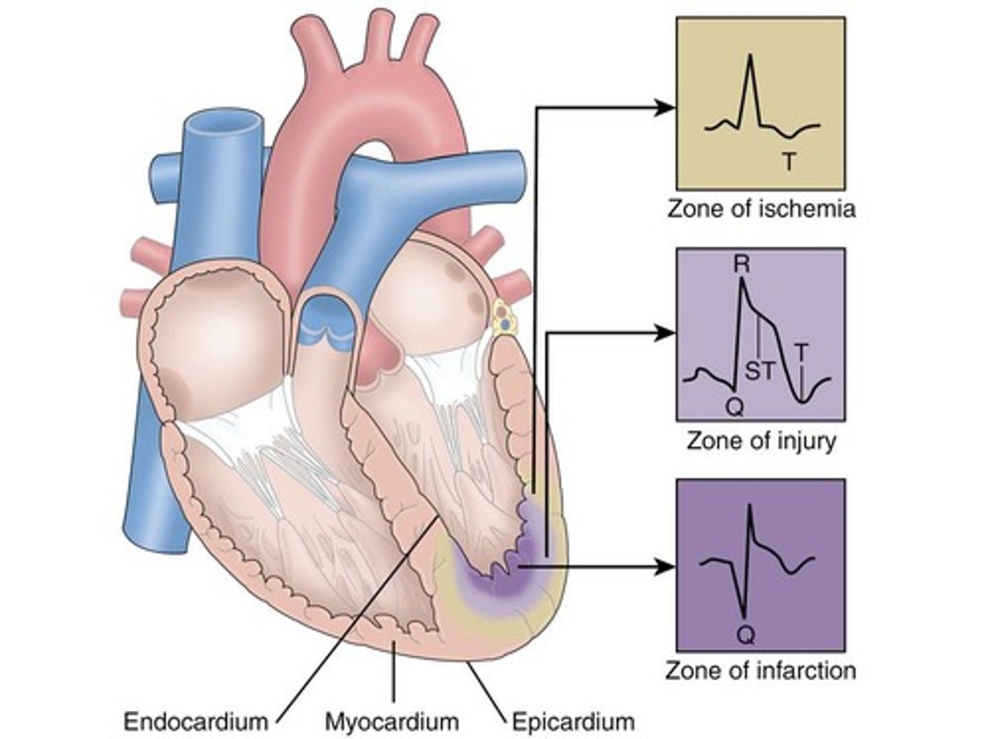 <p>Cardiac biomarkers released when the heart is injured; elevated levels indicate myocardial injury.</p>