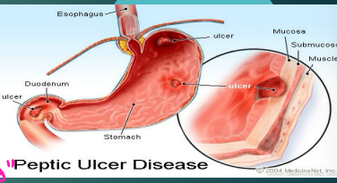 <p><strong>PUD: Gastric Ulcer</strong></p><p>-____ common than duodenal ulcers, seen mostly in 55-65 y/o pts </p><p>-Symptoms</p><ul><li><p>Intermittent ________ pain and dyspepsia in a “food-pain” pattern, meaning it is worse after ______</p></li><li><p>Early satiety </p></li><li><p>_______/vomiting</p></li><li><p>Occasional weight loss</p></li></ul><p></p>