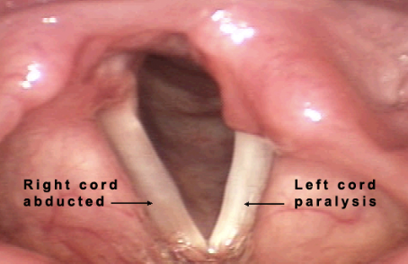 <p>What neurogenic voice disorder is this?</p>