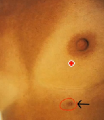 <p>note size, direction, dryness, lesions, bleeding, discharge, retraction, dimpling &amp; presence of <strong>supernumerary nipples</strong>; also note for areolas for color, size, shape, texture &amp; presence of Montgomery tubercles</p><p></p>