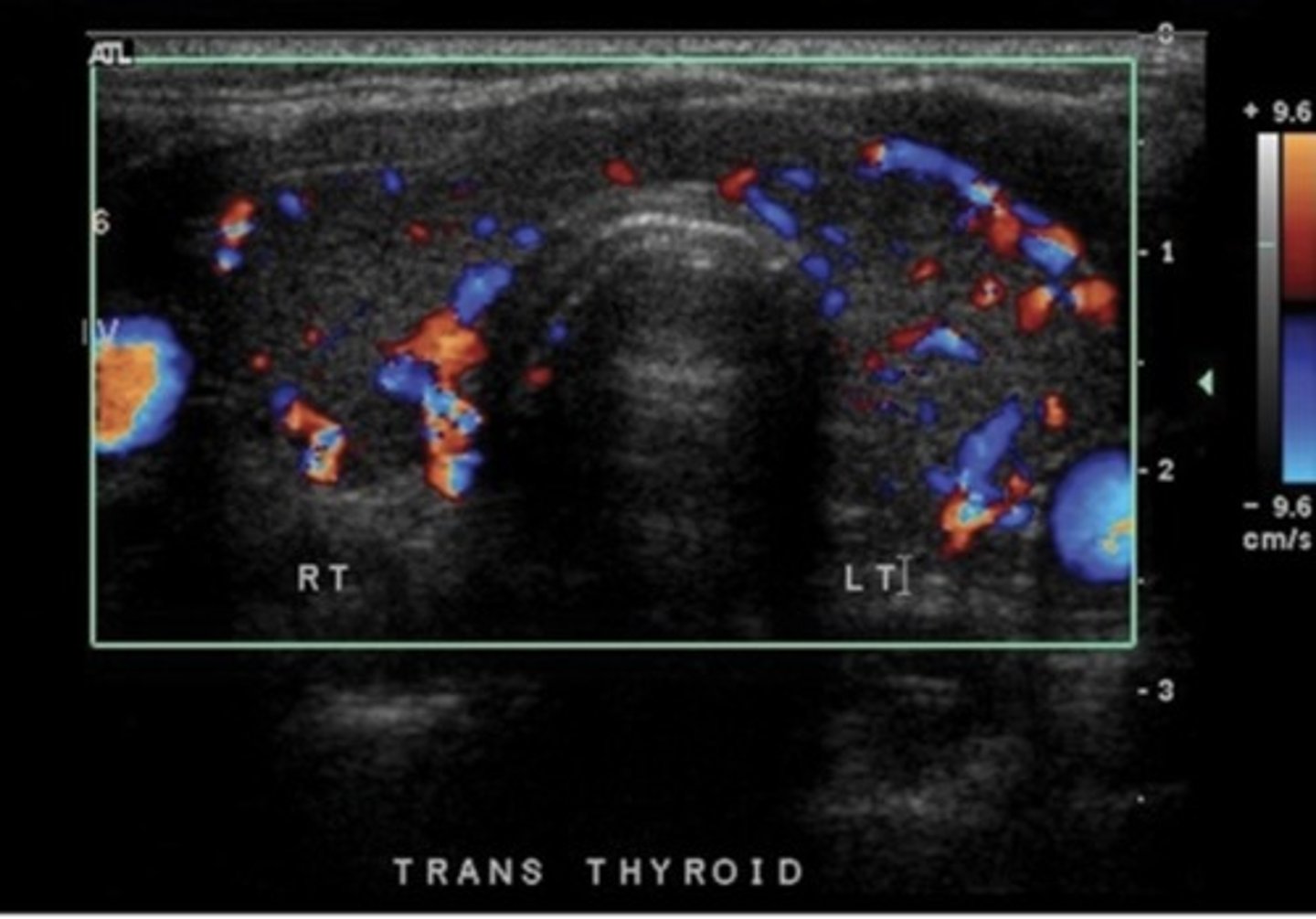<p>High thyroid hormones</p>