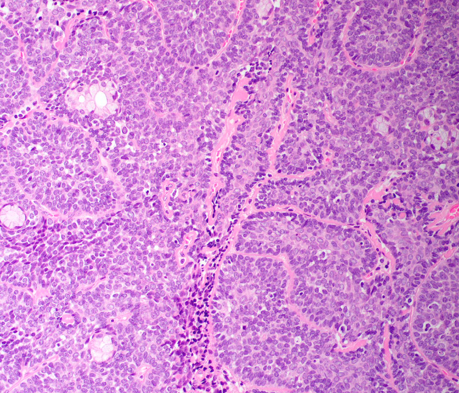 <p>Homme de 60 ans avec tumeur invasive dans la parotide</p><p>1) Diagnostic</p><p>2) epidemio (age, localisation)</p><p>3) Histo</p><p>4) IHC</p><p>5) moléculaire et syndrome lié</p>