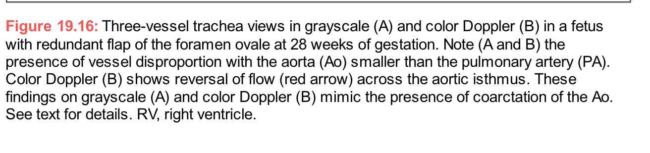 <p>Redundant flap of foremen ovale: great vessel disproportion </p>
