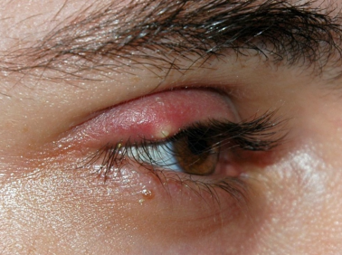 <p>External (stye) - Acute bacterial infection of the lash follicle and its associated gland of Zeiss or moll </p><p>Internal (oil) - Acute bacterial infection of MG - usually staphylococcal, can develop into chalazion </p><p>Sx;</p><ul><li><p>Tender lump in eyelid</p></li><li><p>Epiphora</p></li><li><p>Local redness of eye and lid </p></li></ul><p></p>