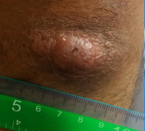 <p>palpable lesions raised above the skin </p><p>Longest diameter is more than 1 cm</p>