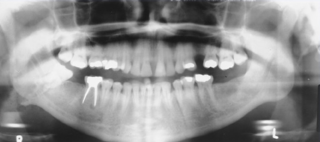<p>What is this x-ray demonstrating?</p>